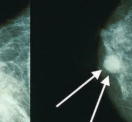 Ácidos grasos en la mama predicen riesgo de cáncer tras la menopausia