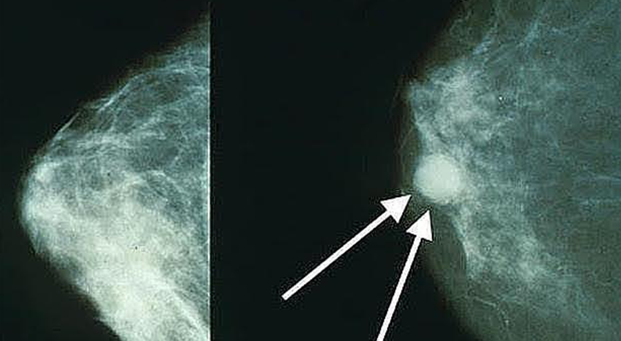 Ácidos grasos en la mama predicen riesgo de cáncer tras la menopausia